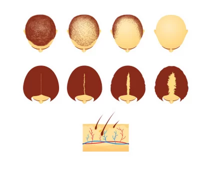 5 Key Causes of Hair Loss – Can You Reverse Hair Loss?