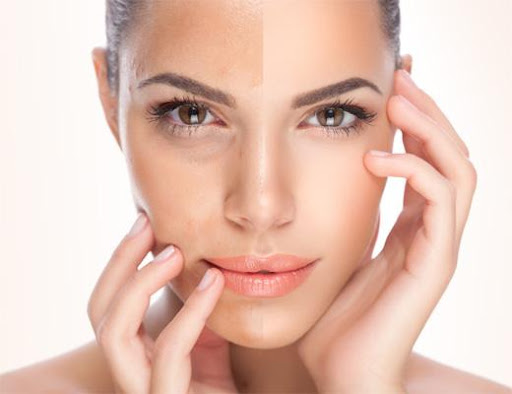 Long Live Lasers: Why Lasers are Still the Go-To Treatment for Clear Skin