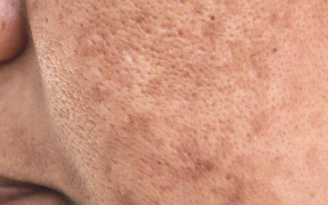 Pigments Explained: Melasma (Part 1)