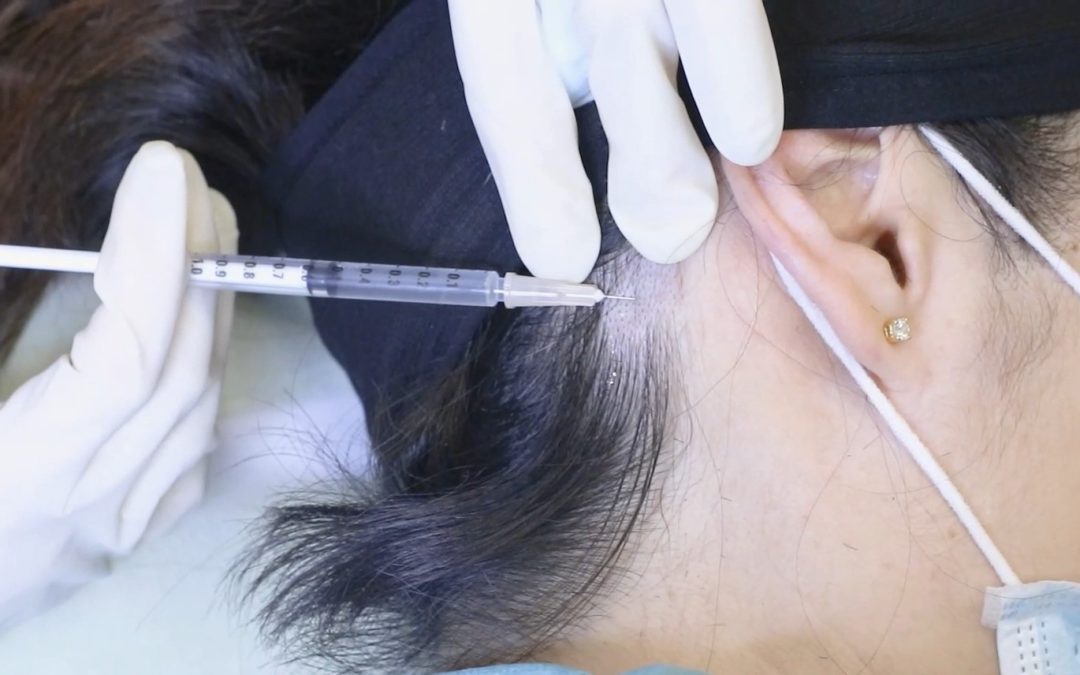 10 Things to Know about Autologous Micrograft Technology (AMT for hair loss) in Singapore