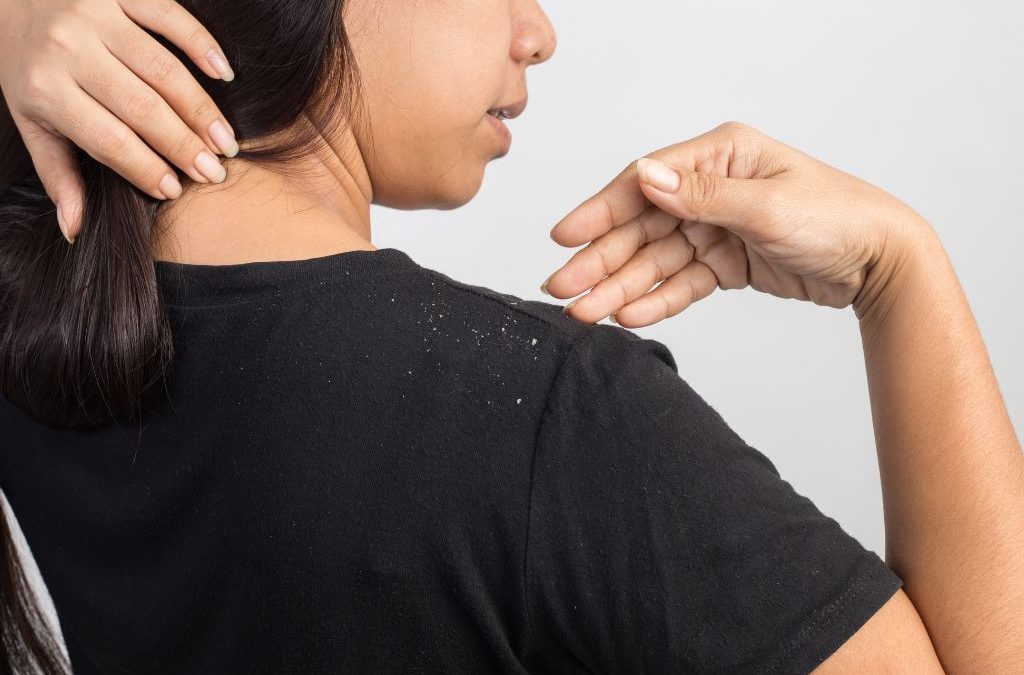 Is Dandruff Causing My Hair to Fall Out?