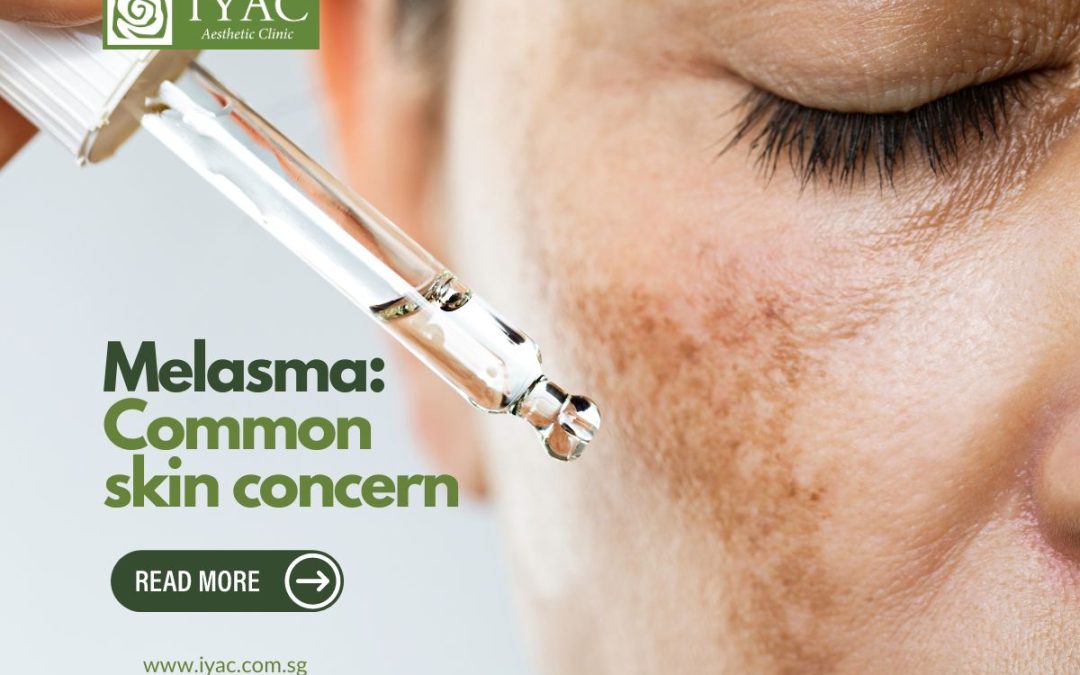 Melasma: Understanding and Managing this Common Skin Concern